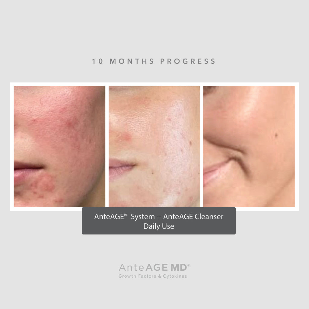 AnteAGE MD Biosome System