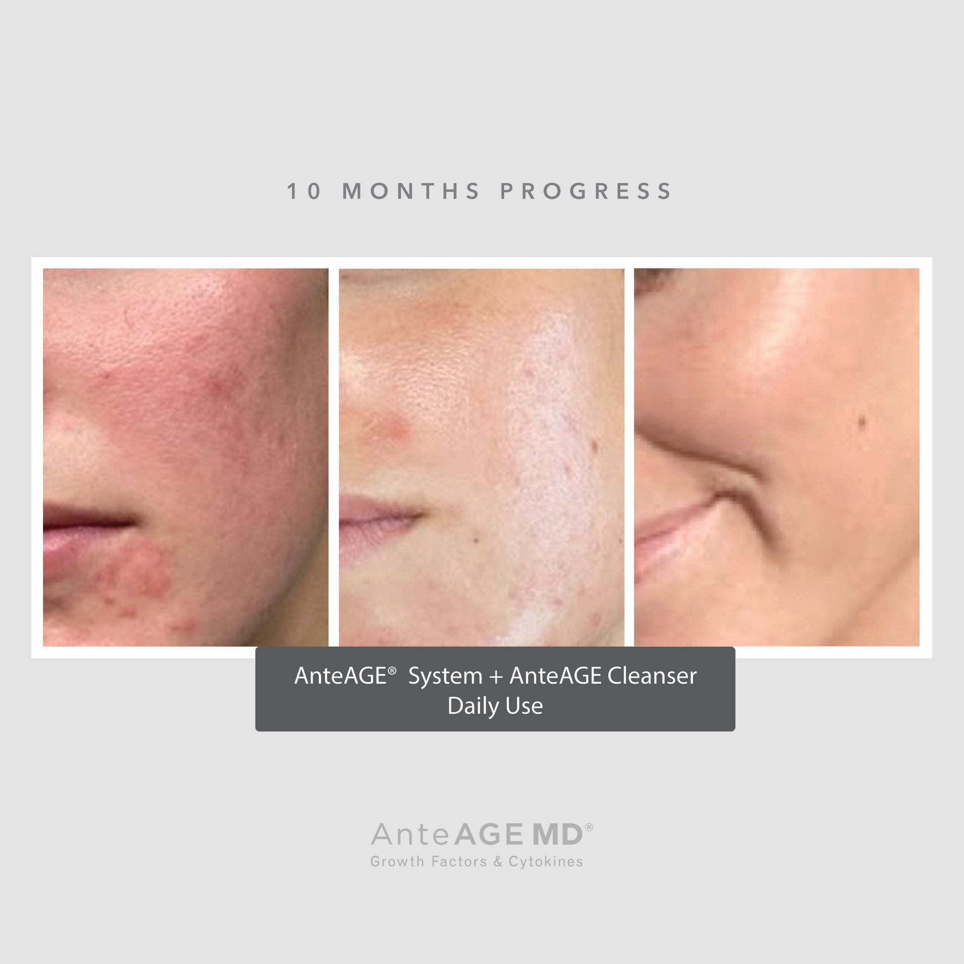 AnteAGE MD Biosome System