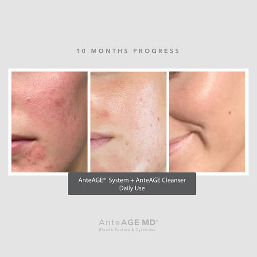 AnteAGE MD Biosome System