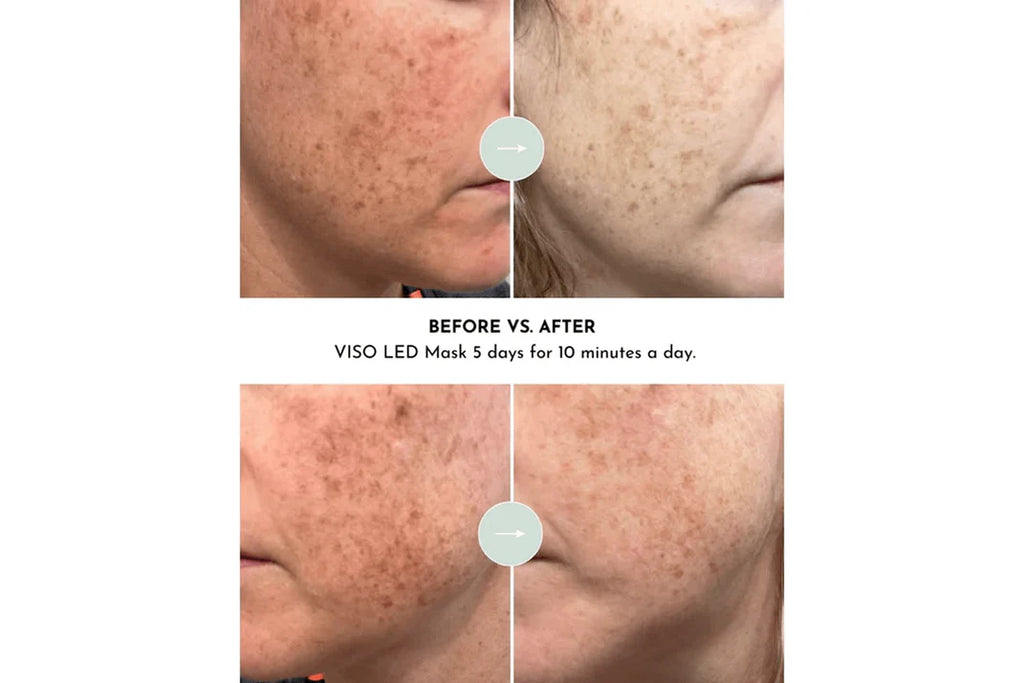 Lumara Viso Red Light Mask