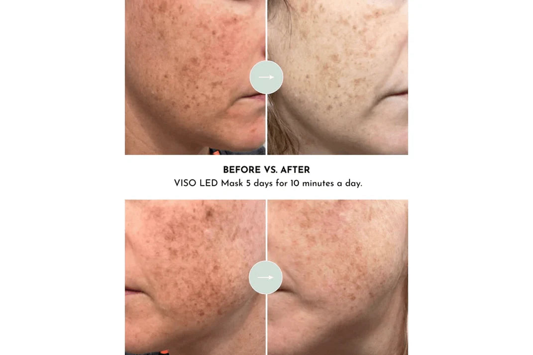 Lumara Viso Red Light Mask